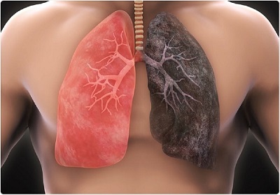 ابتلا به سرطان ریه در افراد سیگاری